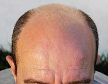 Balding Head