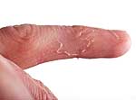 Closeup of eczema on male finger with skin peeling