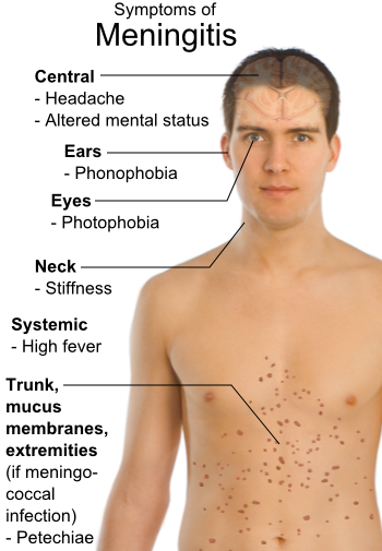 Meningitis is a potentially life-threatening infection of the meninges — the 